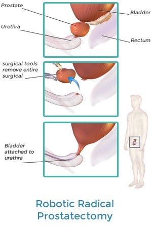 Robotic Radical Prostatectomy