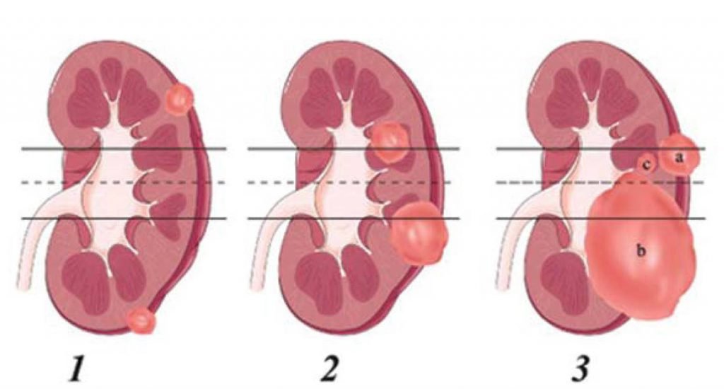 Отекшая почка. Шкала Ренал нефрометрическая. Шкала renal для резекции почки. R.E.N.A.L шкала. Шкала Нефрометрии renal.